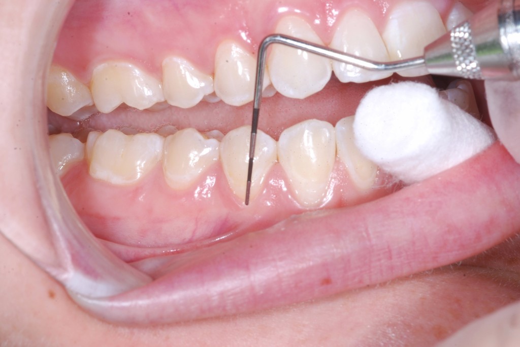 frenectomybefore (1) Laurene K. Duke DDS Total Wellness Dentistry